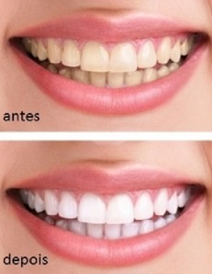 clareamento_dental